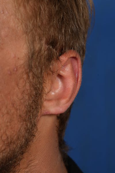 Ear Lobe Repair Before & After Gallery - Patient 279176 - Image 2