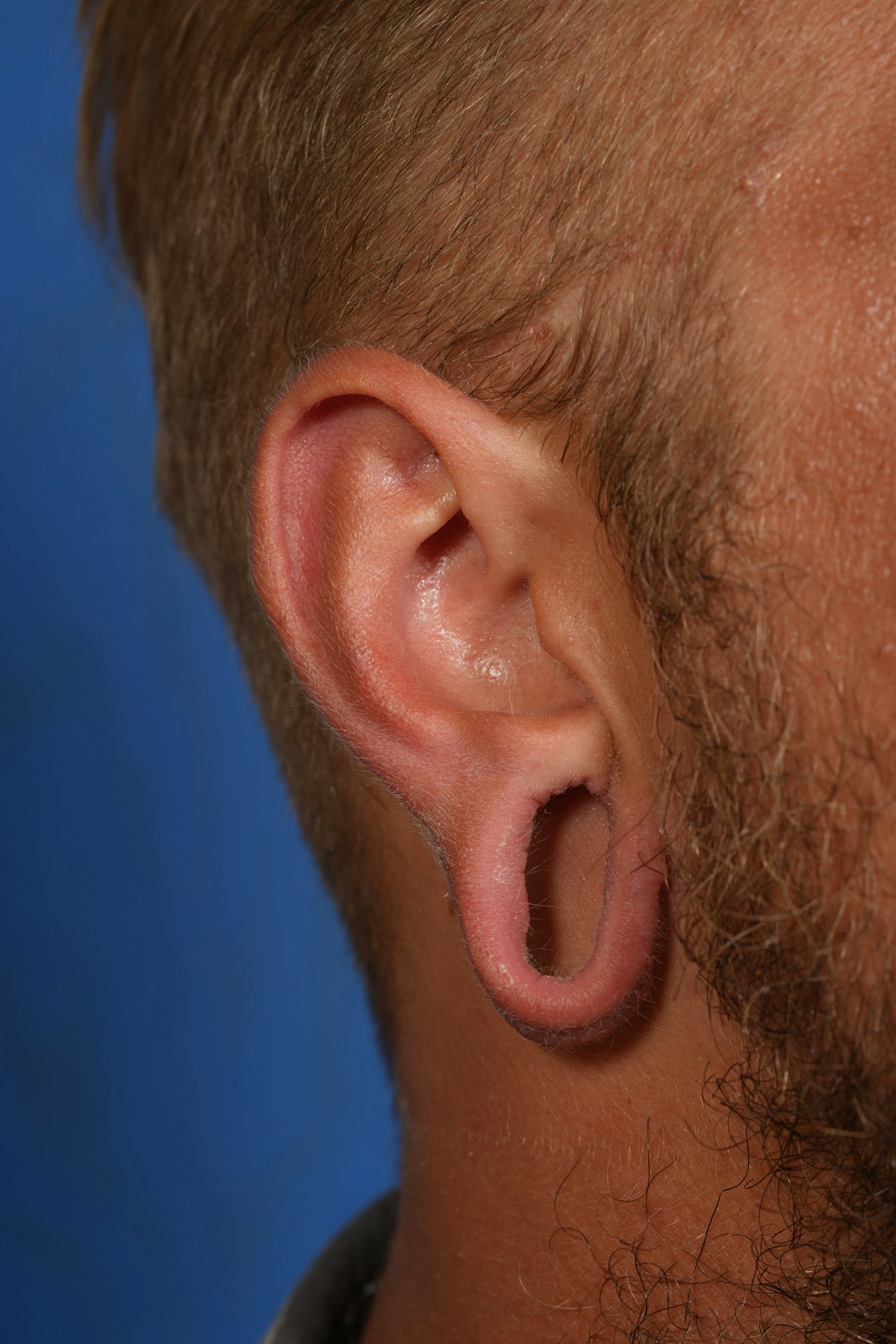 Ear Lobe Repair Before & After Gallery - Patient 279176 - Image 3