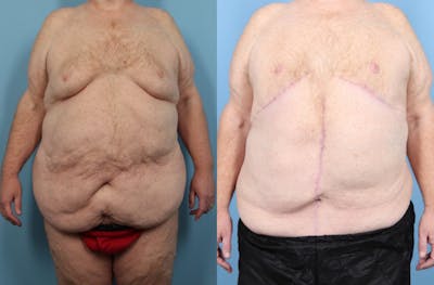 Weight Loss Body Contouring Before & After Gallery - Patient 170675 - Image 1