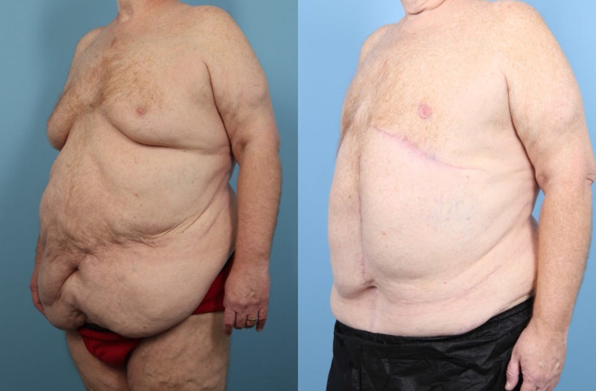 Weight Loss Body Contouring Before & After Gallery - Patient 170675 - Image 2