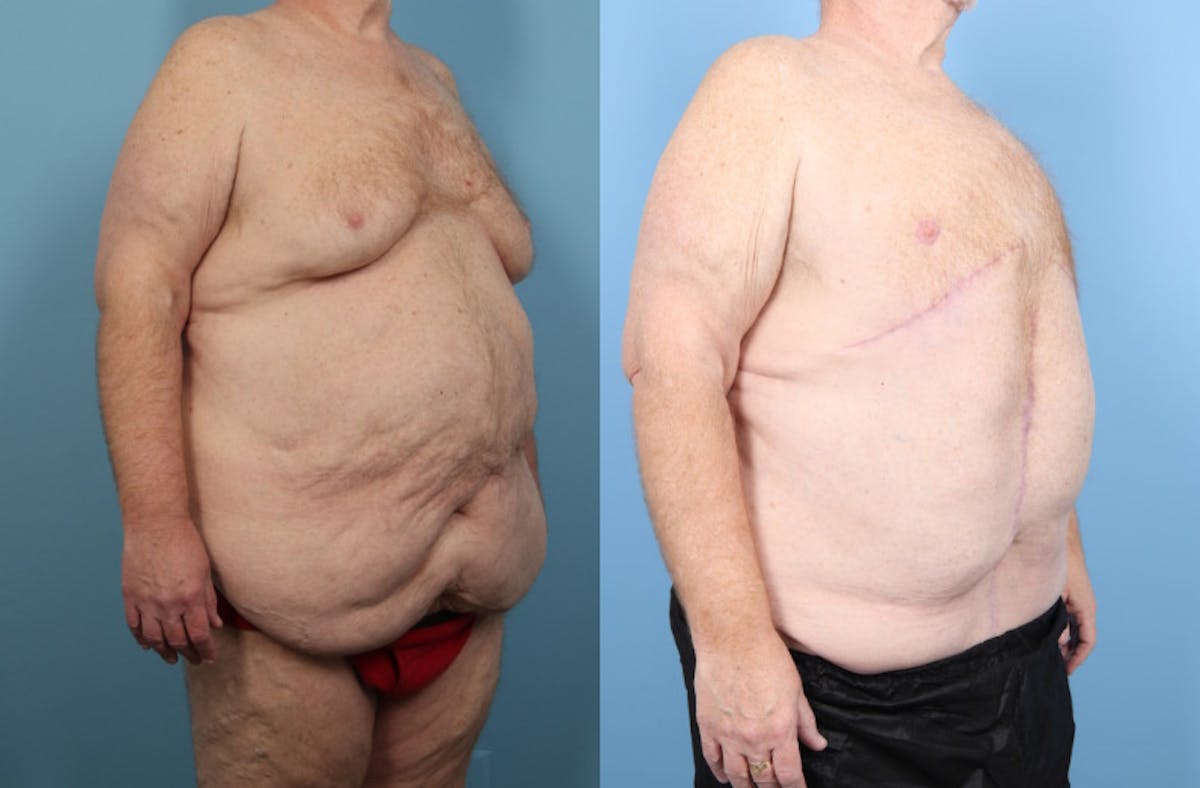 Weight Loss Body Contouring Before & After Gallery - Patient 170675 - Image 3