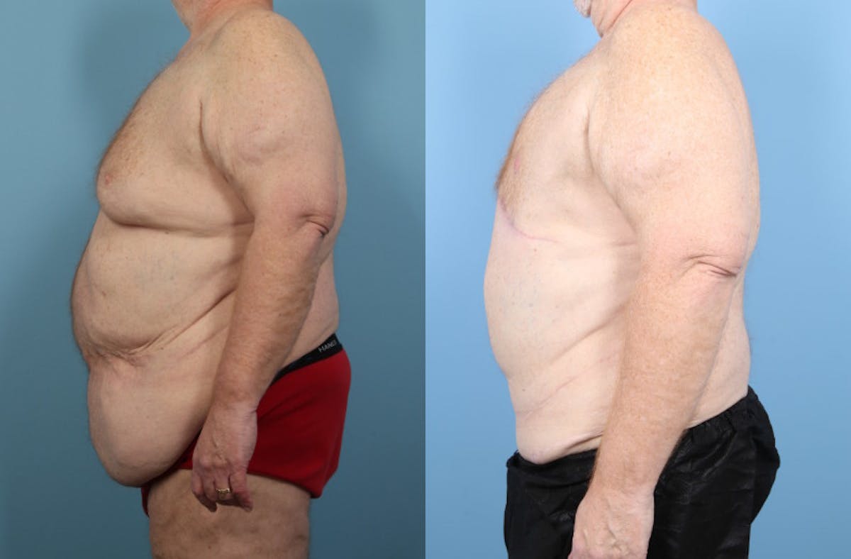Weight Loss Body Contouring Before & After Gallery - Patient 170675 - Image 4