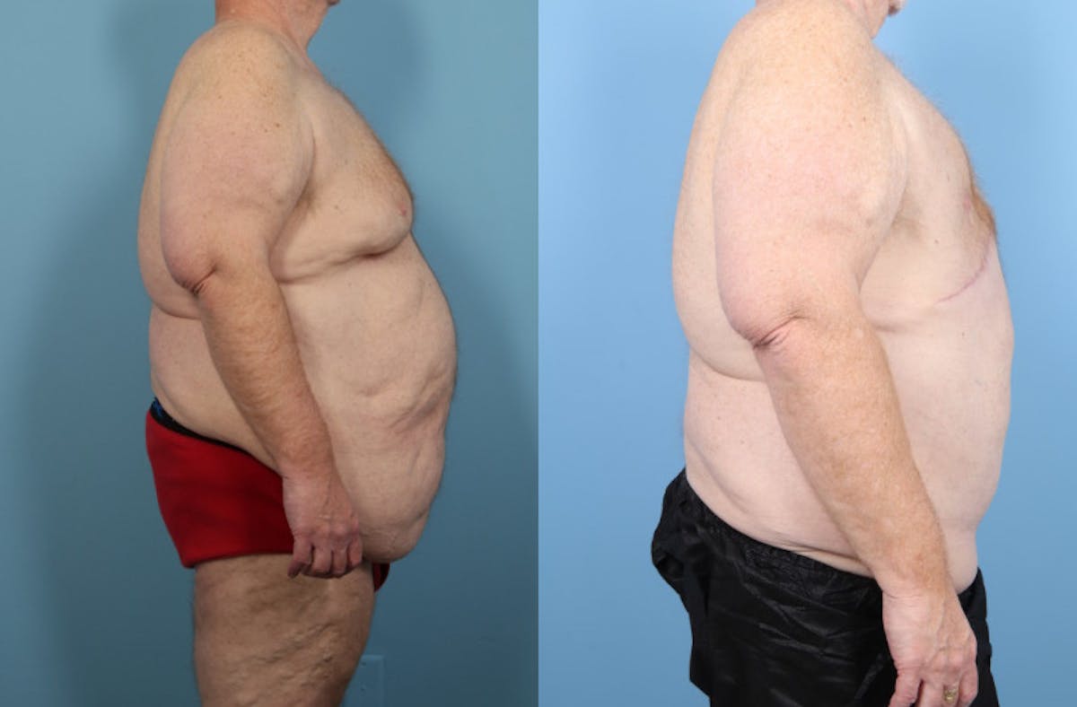 Weight Loss Body Contouring Before & After Gallery - Patient 170675 - Image 5