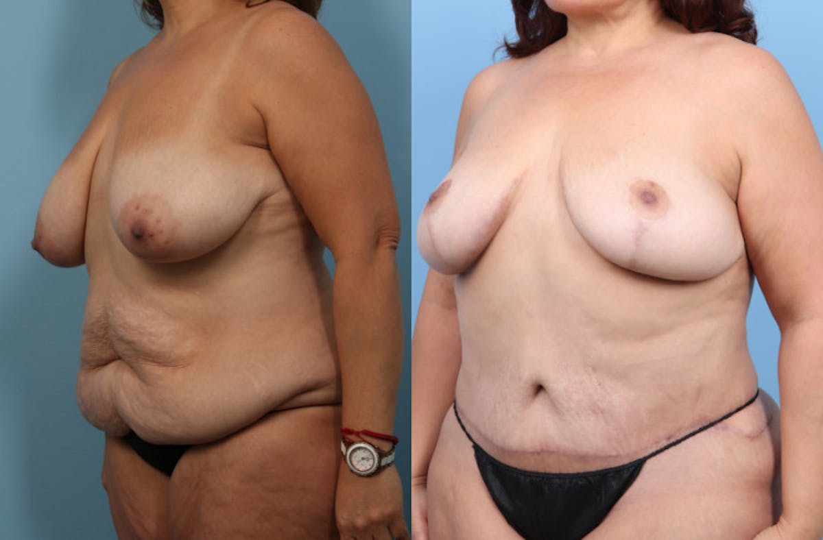 Tummy Tuck Before & After Gallery - Patient 320120 - Image 2