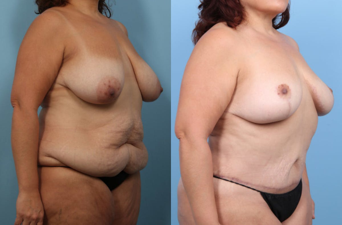 Tummy Tuck Before & After Gallery - Patient 320120 - Image 3
