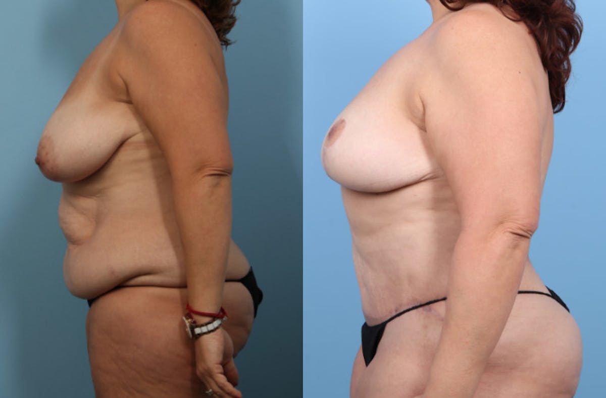 Tummy Tuck Before & After Gallery - Patient 320120 - Image 4