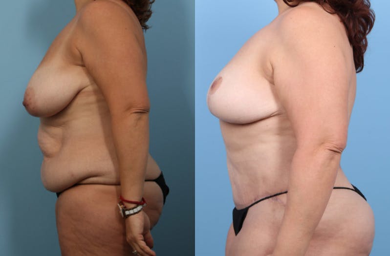 Tummy Tuck Before & After Gallery - Patient 320120 - Image 4