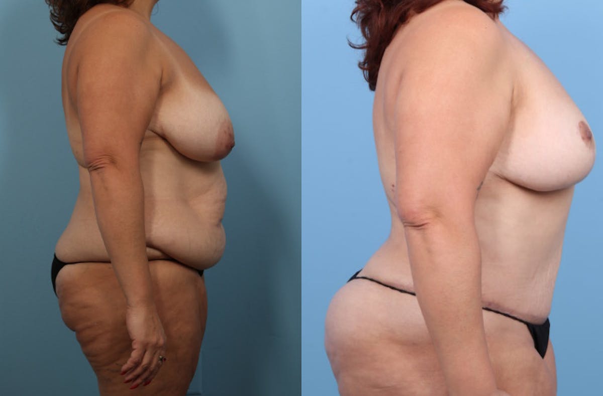 Tummy Tuck Before & After Gallery - Patient 320120 - Image 5