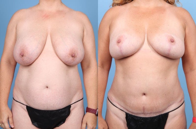 Mommy Makeover Before & After Gallery - Patient 153519 - Image 1