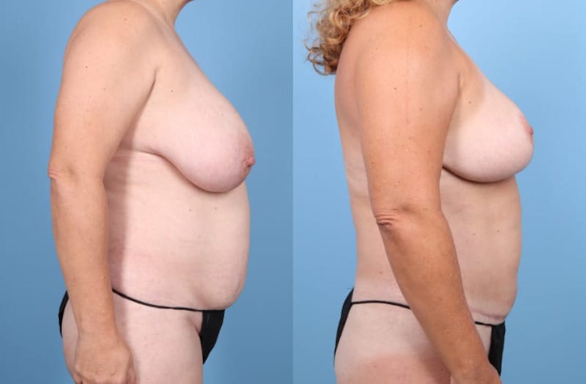 Tummy Tuck Before & After Gallery - Patient 238002 - Image 4