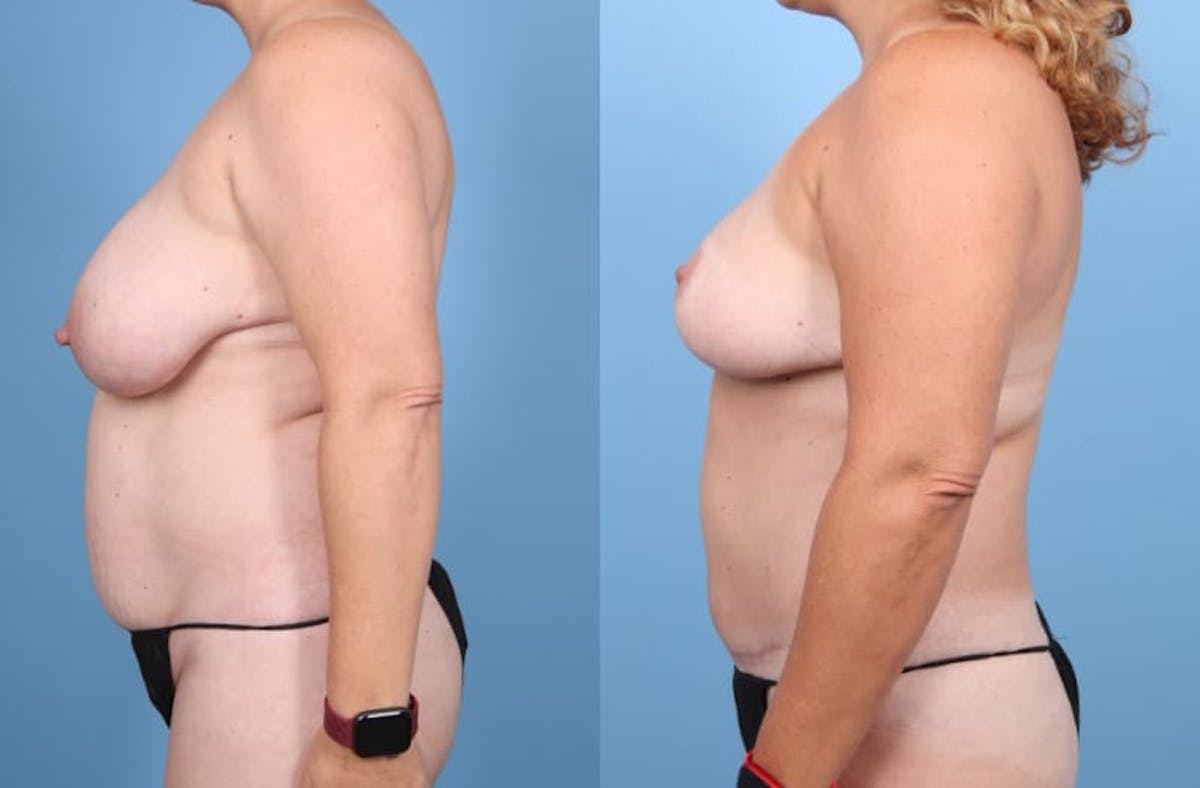 Tummy Tuck Before & After Gallery - Patient 238002 - Image 5