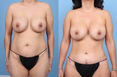 Tummy Tuck Before & After Gallery - Patient 199014 - Image 1