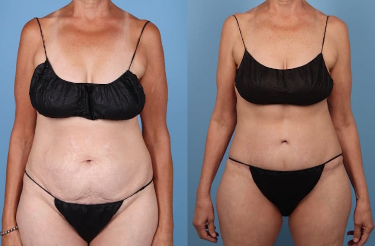 Tummy Tuck Before & After Gallery - Patient 119295 - Image 1