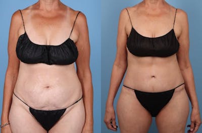 Tummy Tuck Before & After Gallery - Patient 119295 - Image 1