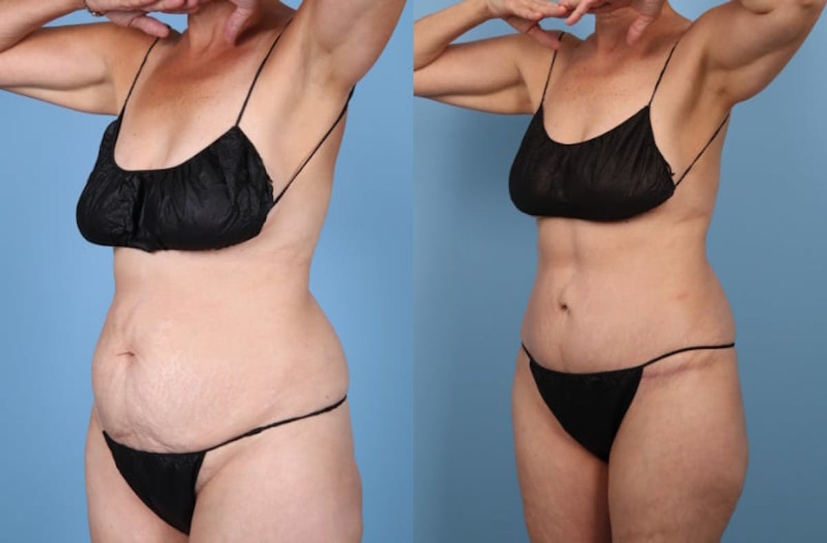 Tummy Tuck Before & After Gallery - Patient 119295 - Image 2