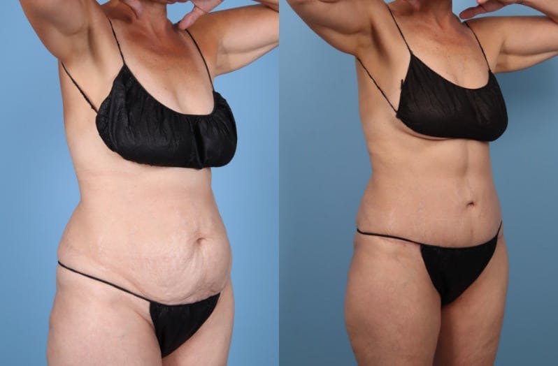 Tummy Tuck Before & After Gallery - Patient 119295 - Image 3