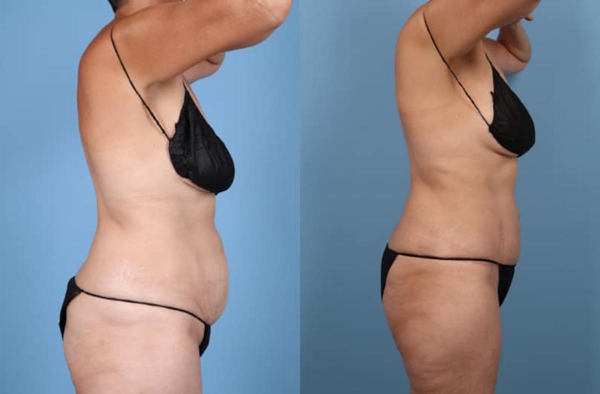 Tummy Tuck Before & After Gallery - Patient 119295 - Image 4