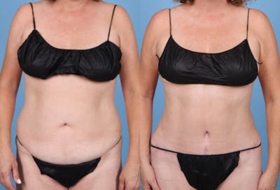 Tummy Tuck Before & After Gallery - Patient 833276 - Image 1