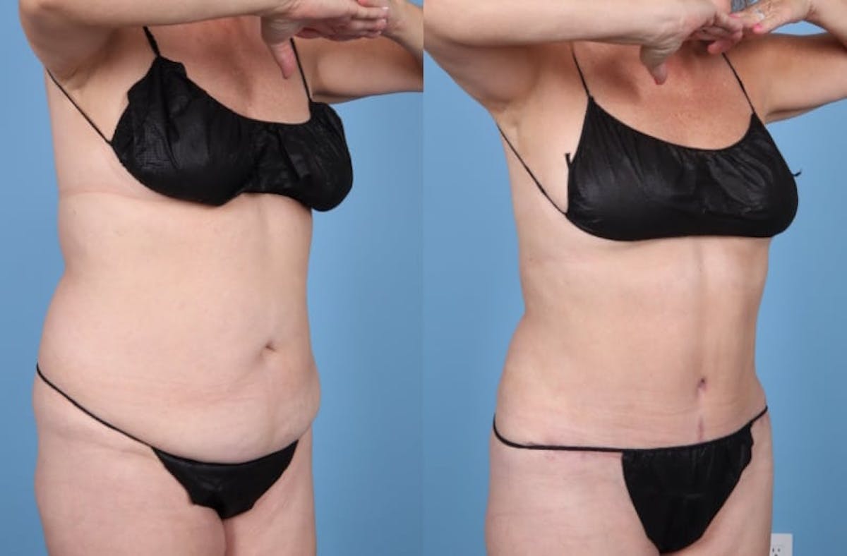 Tummy Tuck Before & After Gallery - Patient 833276 - Image 2