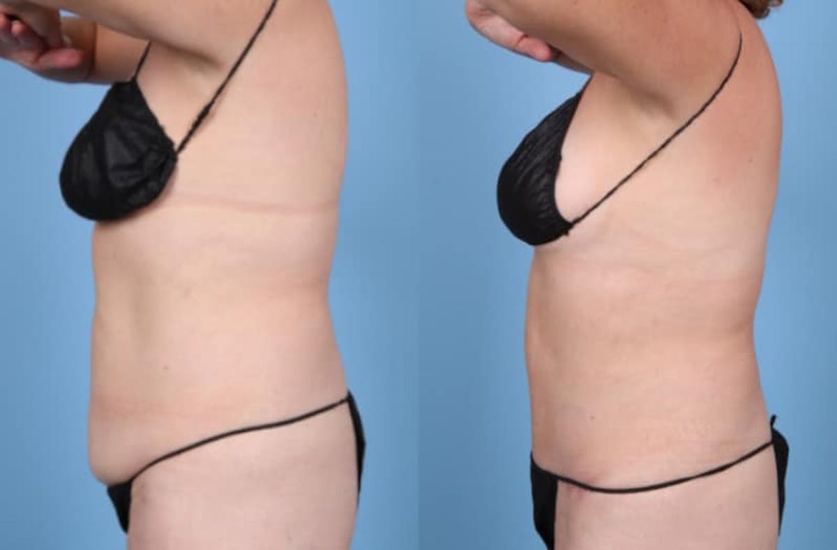 Tummy Tuck Before & After Gallery - Patient 833276 - Image 4
