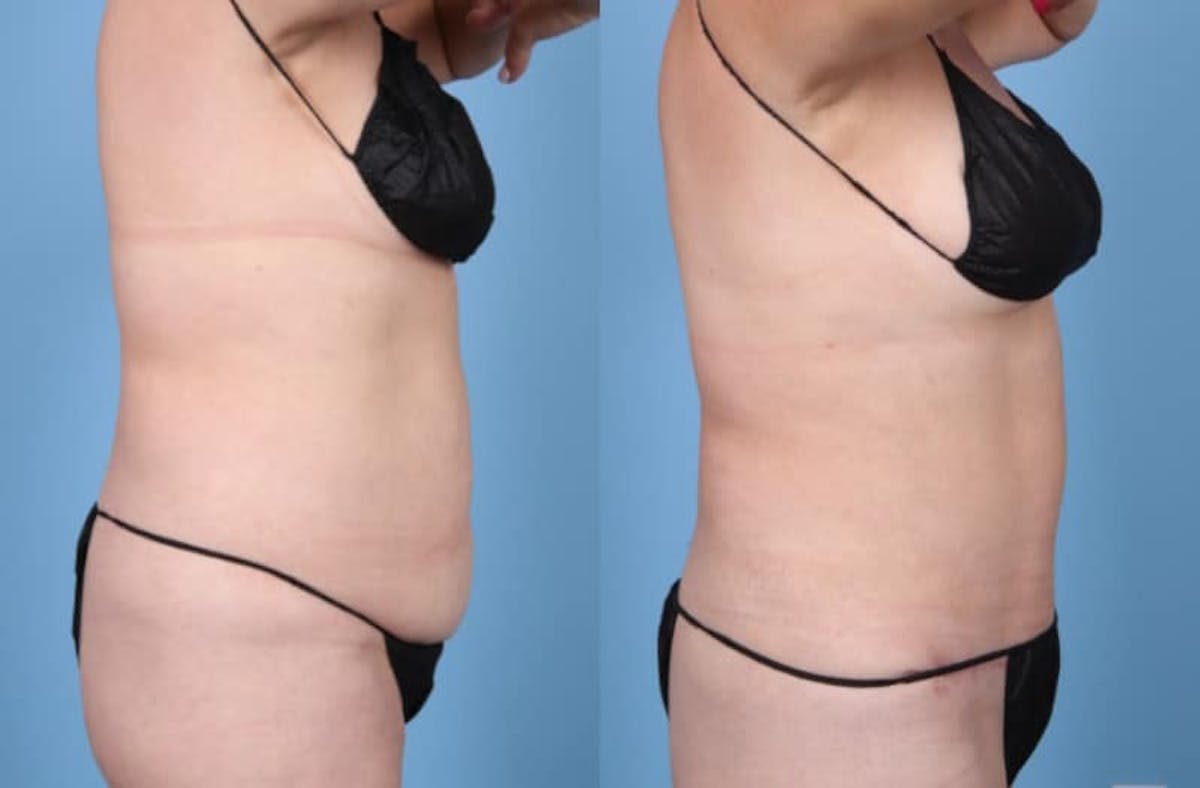 Tummy Tuck Before & After Gallery - Patient 833276 - Image 5