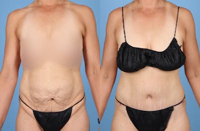 Tummy Tuck Before & After Gallery - Patient 202318 - Image 1