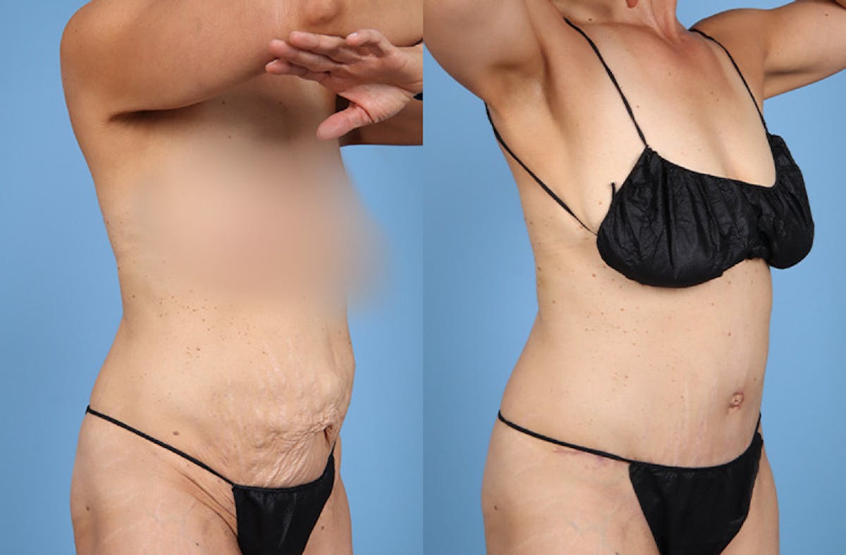 Tummy Tuck Before & After Gallery - Patient 202318 - Image 2