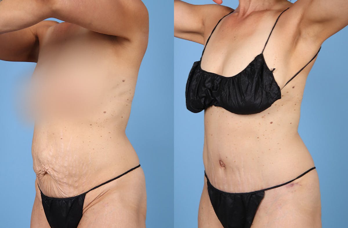 Tummy Tuck Before & After Gallery - Patient 202318 - Image 3