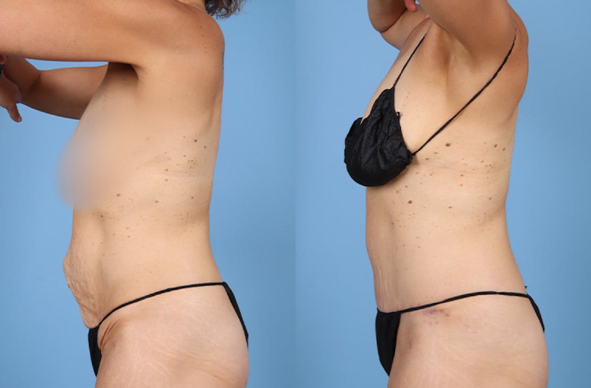 Tummy Tuck Before & After Gallery - Patient 202318 - Image 4