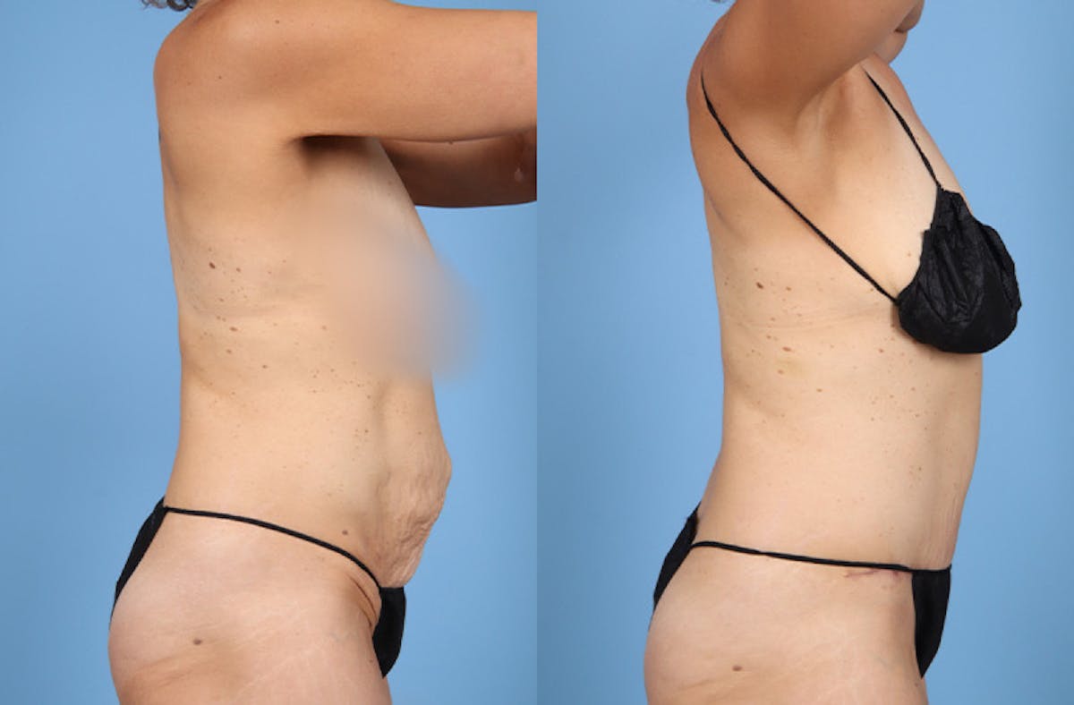 Tummy Tuck Before & After Gallery - Patient 202318 - Image 5