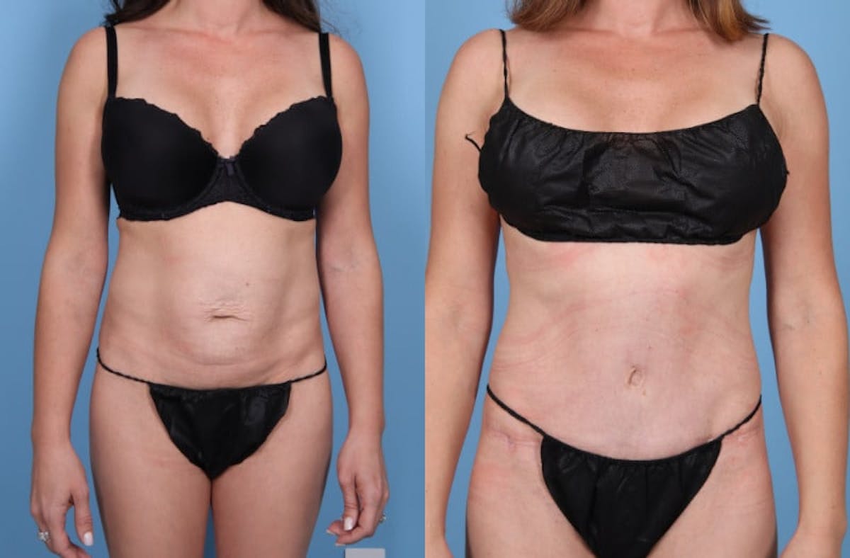Tummy Tuck Before & After Gallery - Patient 321879 - Image 1