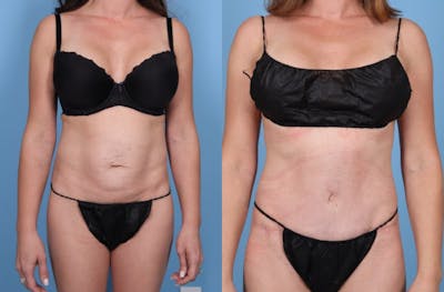 Tummy Tuck Before & After Gallery - Patient 321879 - Image 1