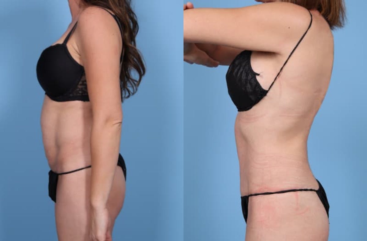 Tummy Tuck Before & After Gallery - Patient 321879 - Image 4