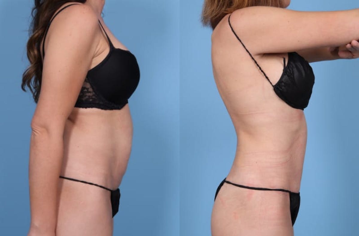 Tummy Tuck Before & After Gallery - Patient 321879 - Image 5
