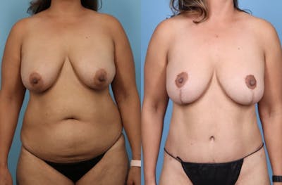 Tummy Tuck Before & After Gallery - Patient 580444 - Image 1