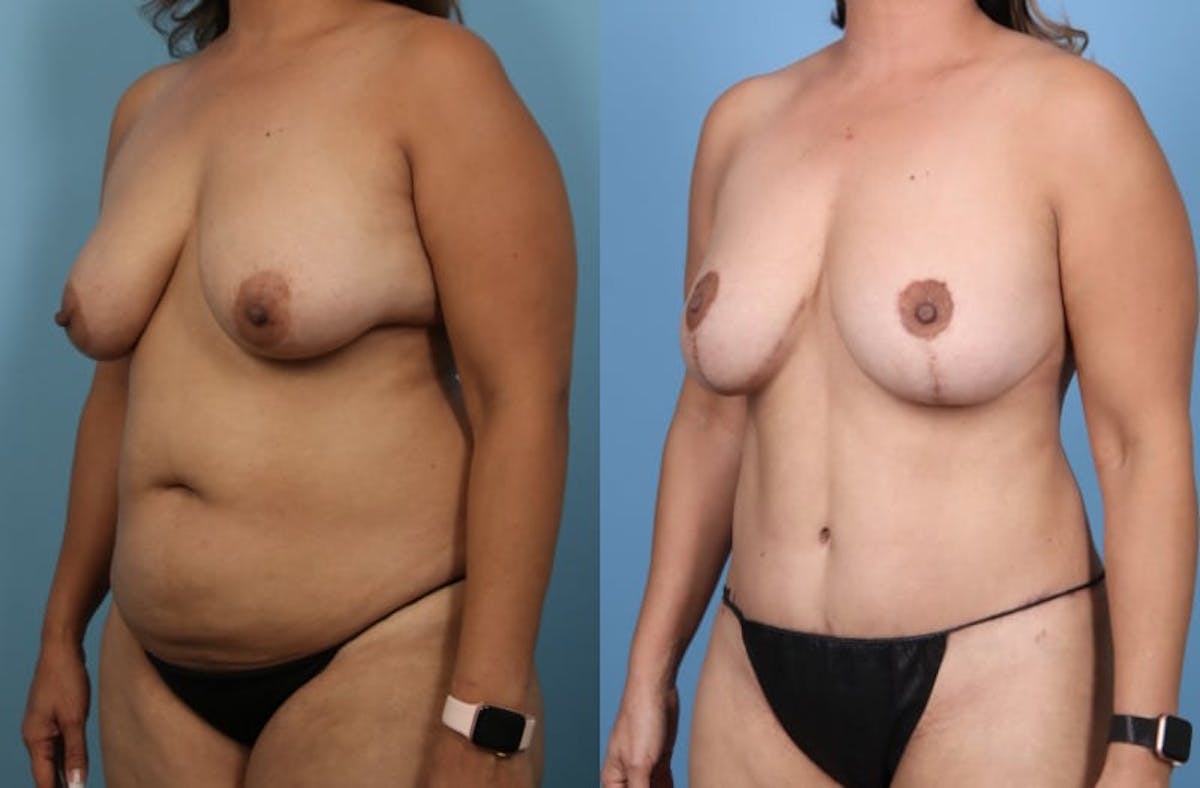 Tummy Tuck Before & After Gallery - Patient 580444 - Image 2