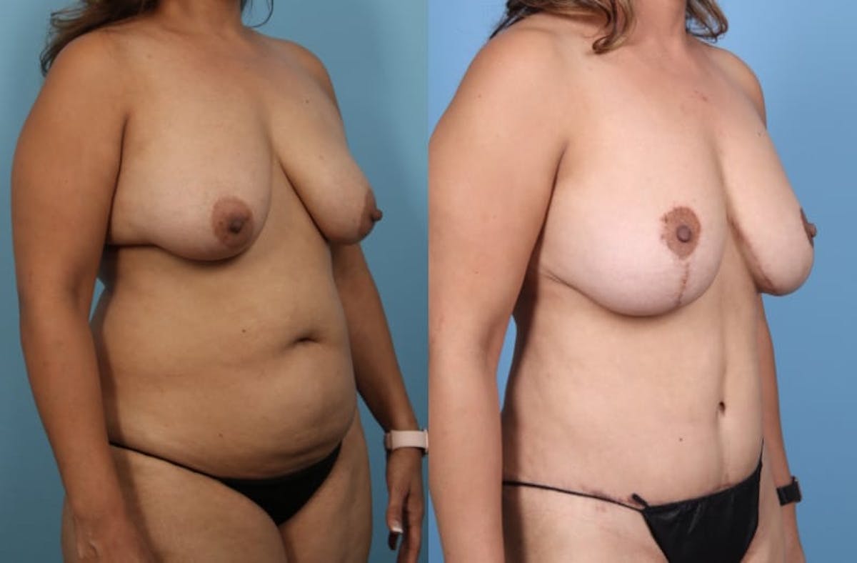 Tummy Tuck Before & After Gallery - Patient 580444 - Image 3
