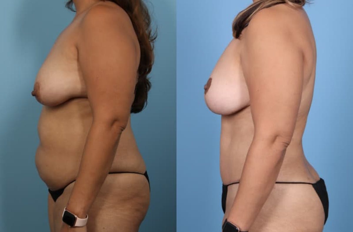 Tummy Tuck Before & After Gallery - Patient 580444 - Image 4