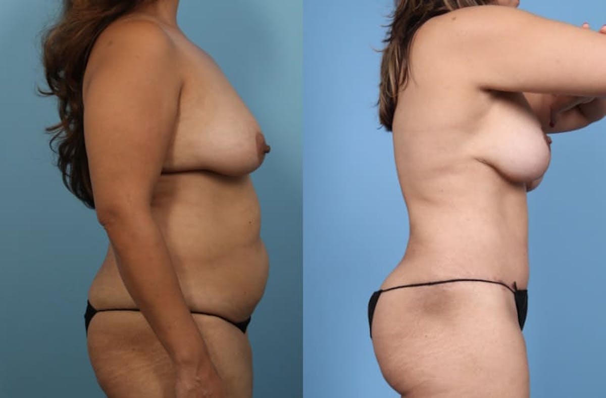 Tummy Tuck Before & After Gallery - Patient 580444 - Image 5