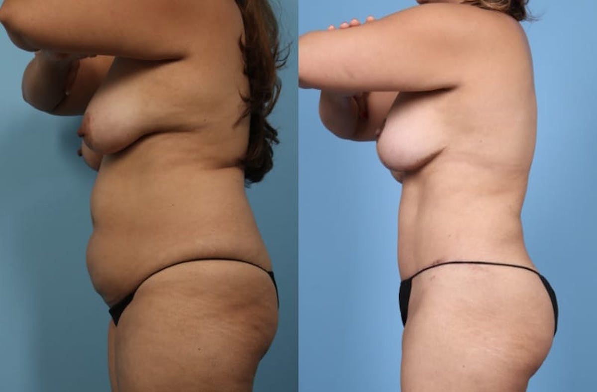 Tummy Tuck Before & After Gallery - Patient 580444 - Image 6