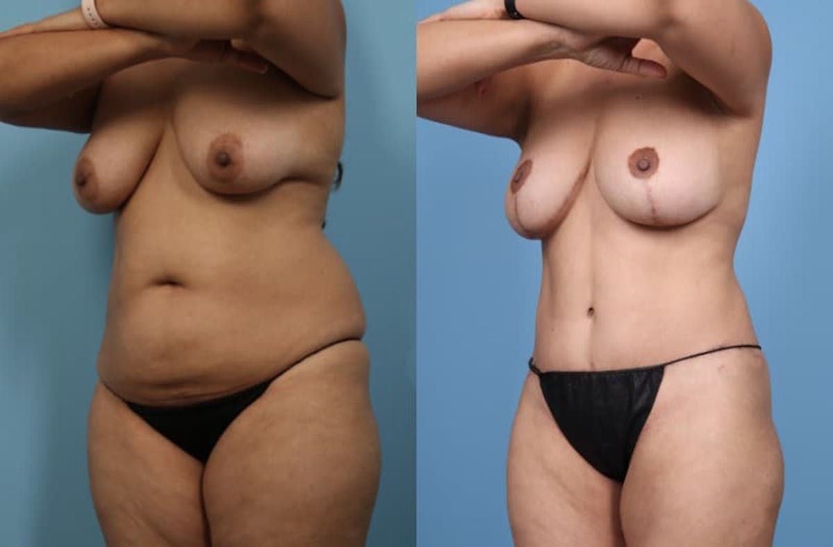 Tummy Tuck Before & After Gallery - Patient 580444 - Image 7