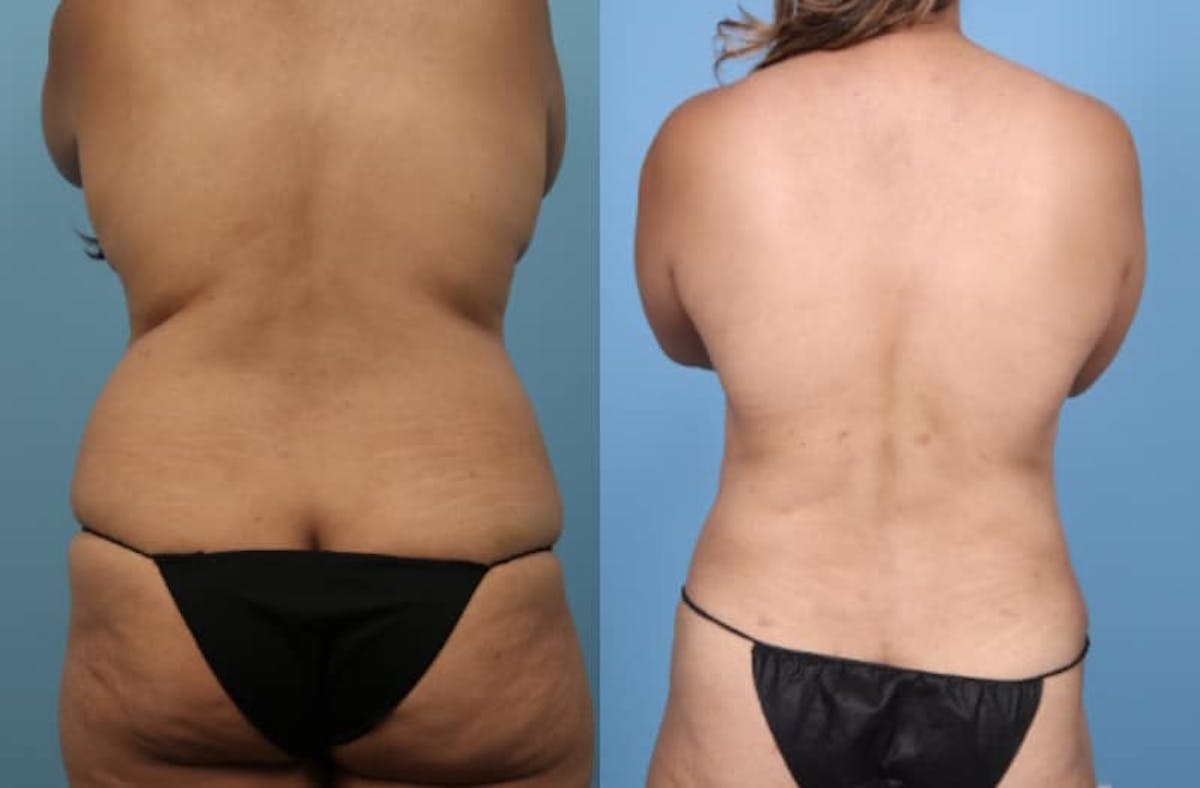 Tummy Tuck Before & After Gallery - Patient 580444 - Image 8