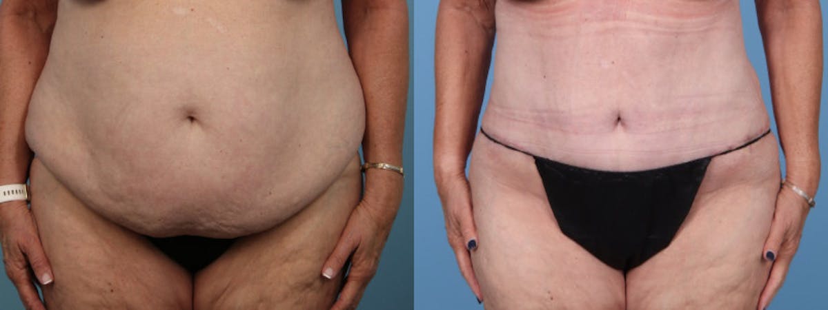 Tummy Tuck Before & After Gallery - Patient 343938 - Image 1