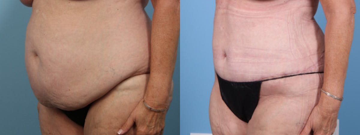 Tummy Tuck Before & After Gallery - Patient 343938 - Image 2