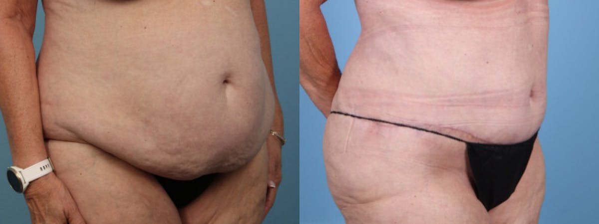 Tummy Tuck Before & After Gallery - Patient 343938 - Image 3