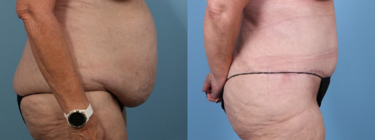 Tummy Tuck Before & After Gallery - Patient 343938 - Image 4