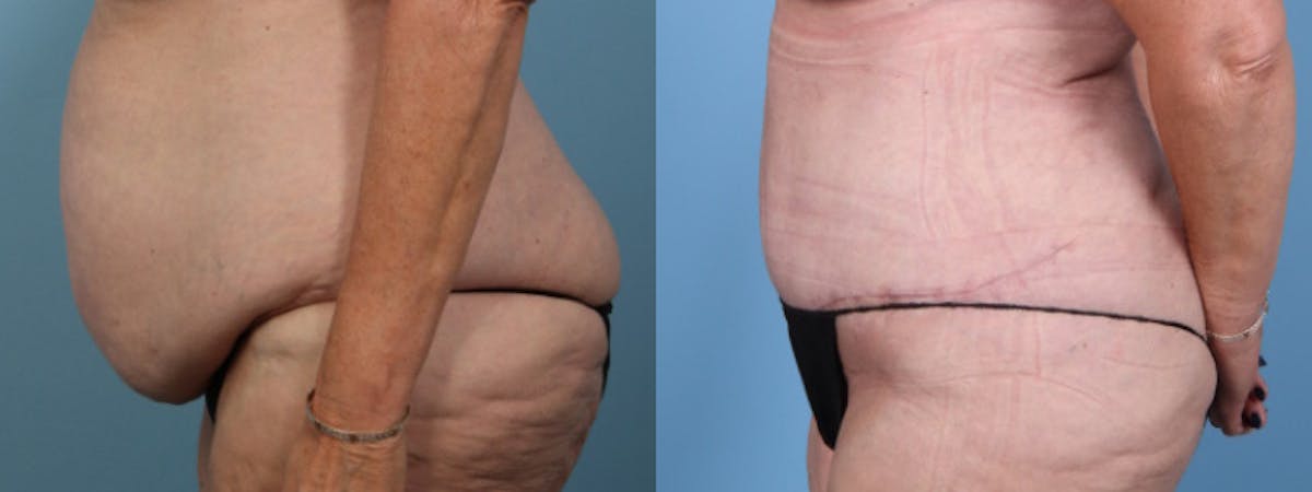 Tummy Tuck Before & After Gallery - Patient 343938 - Image 5