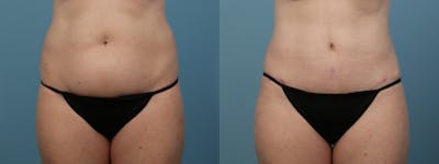 Tummy Tuck Before & After Gallery - Patient 282639 - Image 1