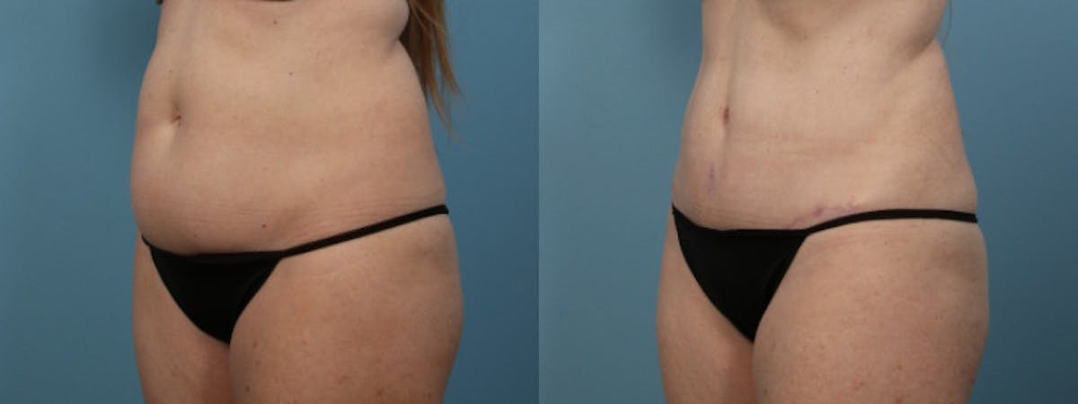 Tummy Tuck Before & After Gallery - Patient 282639 - Image 2