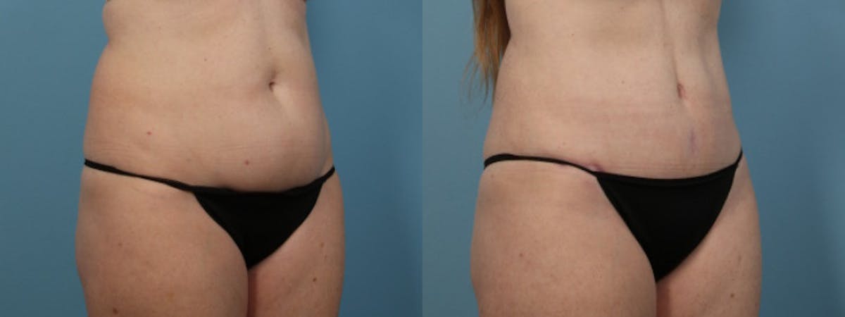 Tummy Tuck Before & After Gallery - Patient 282639 - Image 3